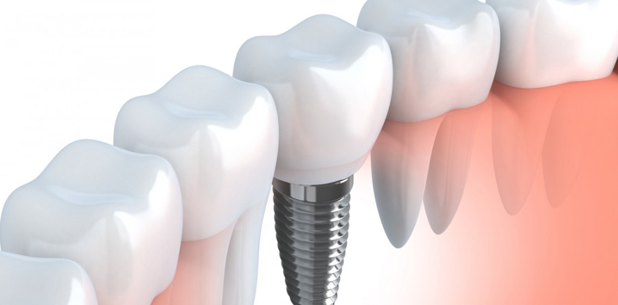 Dental implants