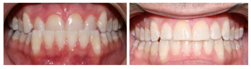Invisalign Before and After: Example 1