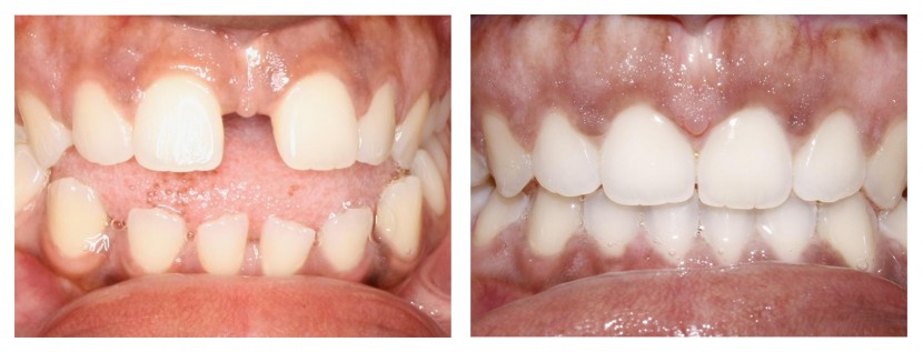 Invisalign Before and After: Example 3