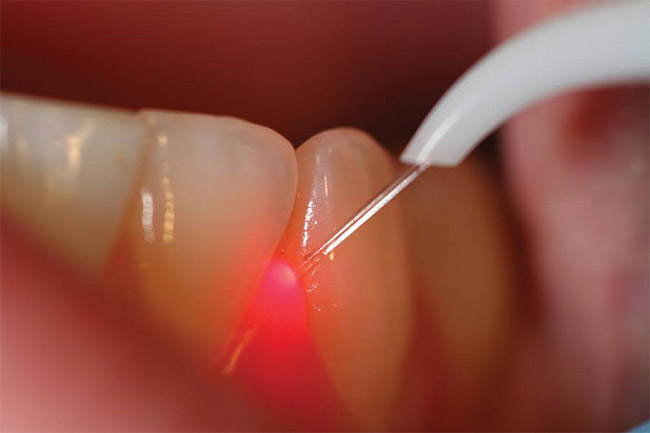 Laser dentistry
